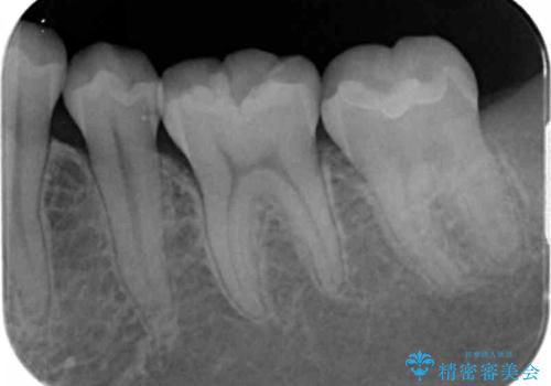奥歯の虫歯 セラミックインレーでの治療の治療後