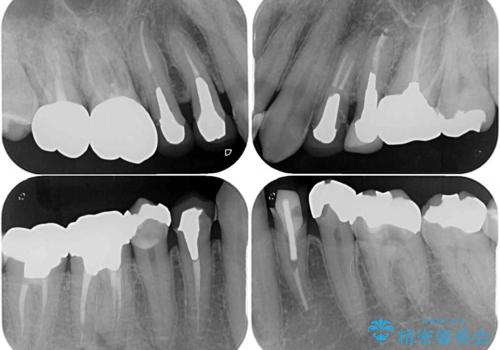 飛び出した前歯と目立つ銀歯 矯正とセラミックの総合歯科診療の治療前