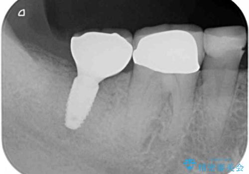 インプラントや歯周外科処置を用いた奥歯の補綴治療の治療後