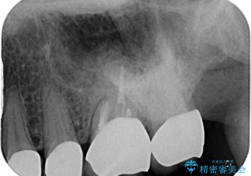 インプラントや歯周外科処置を用いた奥歯の補綴治療の治療後