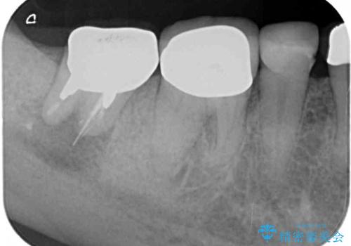 インプラントや歯周外科処置を用いた奥歯の補綴治療の治療前