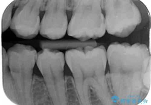 歯と歯の間の虫歯　セラミックインレーでの治療の治療前