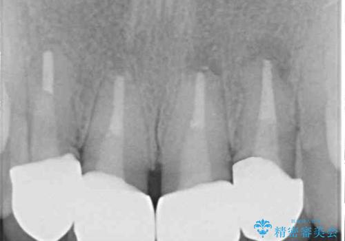 汚れた仮歯が気になる 前歯のオールセラミッククラウンの治療後