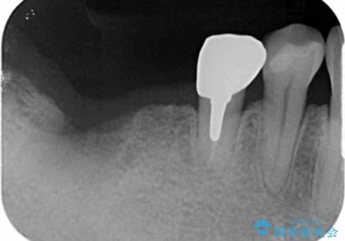 くいしばりで割れたブリッジの支台歯　インプラント再補綴の治療中