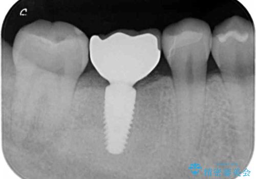 保存不可能な虫歯、インプラントによる機能回復の治療後