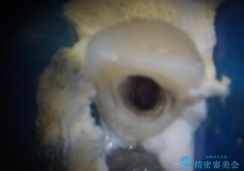 鼻の下を押すと痛い 前歯の根管治療とオールセラミッククラウンの治療前