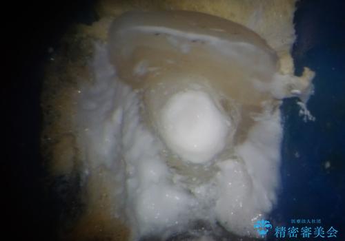 鼻の下を押すと痛い 前歯の根管治療とオールセラミッククラウンの治療中