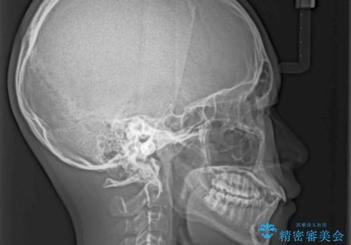 前歯の隙間とデコボコを改善 高校生のインビザライン治療の治療前