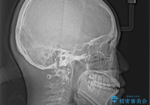 【モニター】隙間だらけの前歯を治したい インビザラインによる矯正治療の治療前