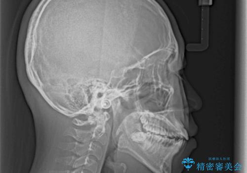上下非接触で突出した前歯 ワイヤー装置による抜歯矯正の治療前