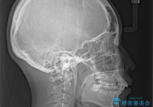 【モニター】治療途中で引っ越し ワイヤー装置を用いた抜歯矯正の治療前