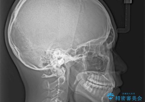 前歯の隙間とデコボコを改善 高校生のインビザライン治療の治療後