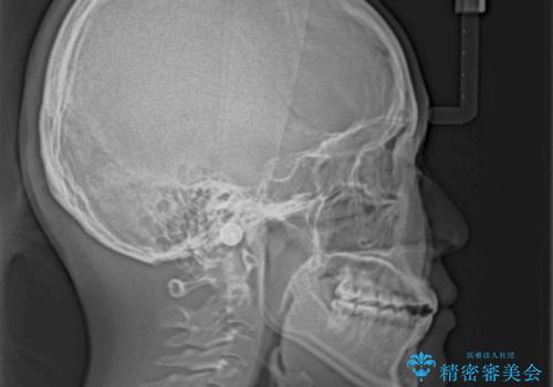 【モニター】隙間だらけの前歯を治したい インビザラインによる矯正治療の治療後