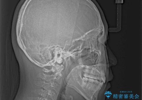 上下非接触で突出した前歯 ワイヤー装置による抜歯矯正の治療後