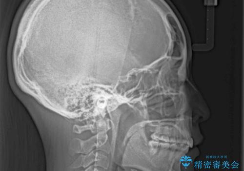 【モニター】治療途中で引っ越し ワイヤー装置を用いた抜歯矯正の治療後