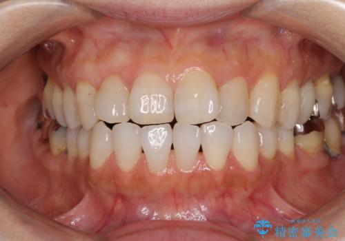 前歯の突出感と上下の隙間　インビザラインによる矯正治療の症例 治療前