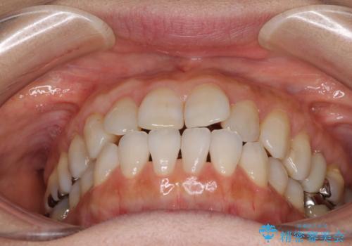 前歯の突出感と上下の隙間　インビザラインによる矯正治療の治療前