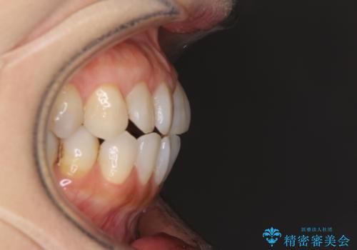 前歯の突出感と上下の隙間 インビザラインによる矯正治療の治療前