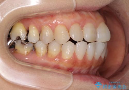 前歯の突出感と上下の隙間 インビザラインによる矯正治療の治療前