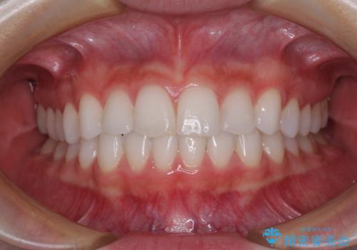 歯をきれいにしたい　ワイヤー矯正治療と虫歯治療の症例 治療後