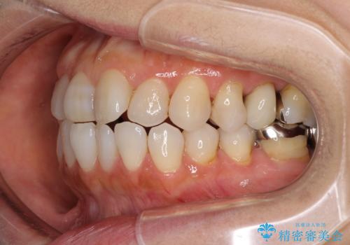 前歯の突出感と上下の隙間 インビザラインによる矯正治療の治療前