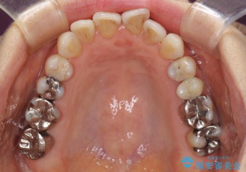 前歯の突出感と上下の隙間 インビザラインによる矯正治療の治療前