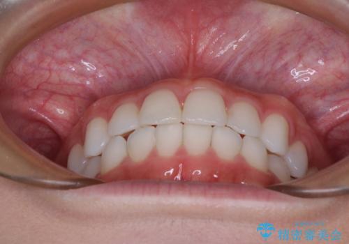 歯をきれいにしたい ワイヤー矯正治療と虫歯治療の治療後