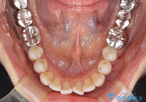 前歯の突出感と上下の隙間 インビザラインによる矯正治療の治療前