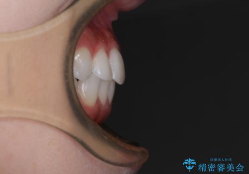 歯をきれいにしたい ワイヤー矯正治療と虫歯治療の治療後