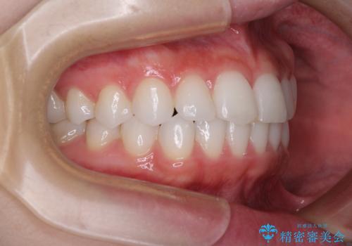 歯をきれいにしたい ワイヤー矯正治療と虫歯治療の治療後