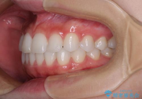 歯をきれいにしたい ワイヤー矯正治療と虫歯治療の治療後