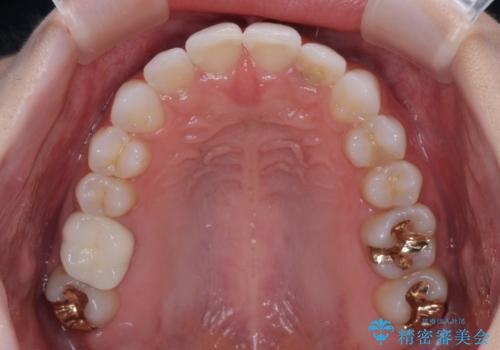 歯をきれいにしたい　ワイヤー矯正治療と虫歯治療の治療後