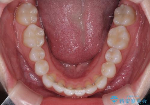 歯をきれいにしたい ワイヤー矯正治療と虫歯治療の治療後