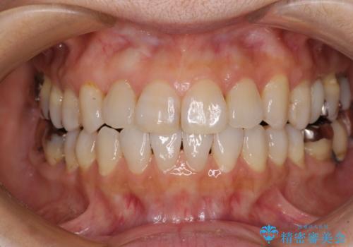 前歯の突出感と上下の隙間 インビザラインによる矯正治療の治療中