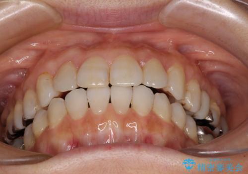 前歯の突出感と上下の隙間　インビザラインによる矯正治療の治療中