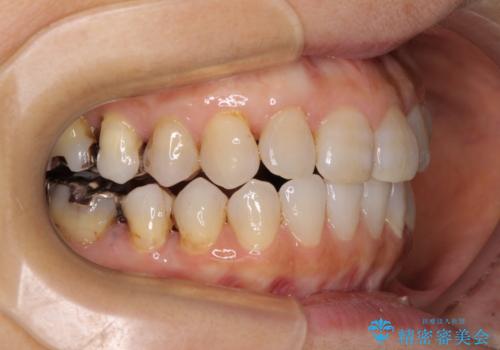 前歯の突出感と上下の隙間 インビザラインによる矯正治療の治療中