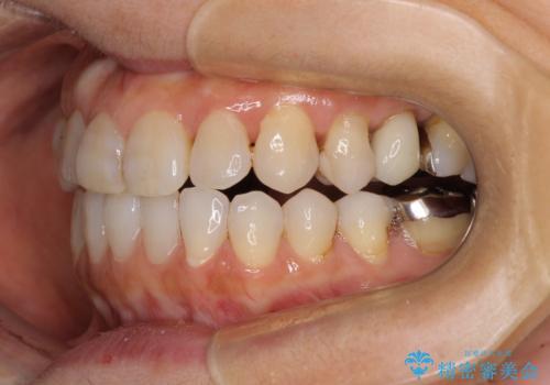 前歯の突出感と上下の隙間 インビザラインによる矯正治療の治療中