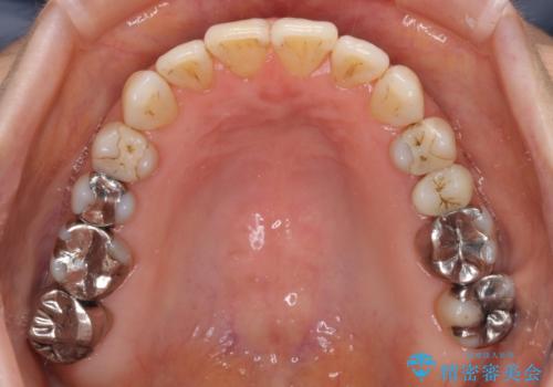 前歯の突出感と上下の隙間　インビザラインによる矯正治療の治療中