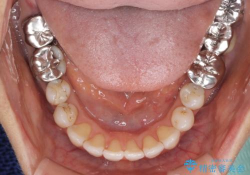 前歯の突出感と上下の隙間 インビザラインによる矯正治療の治療中