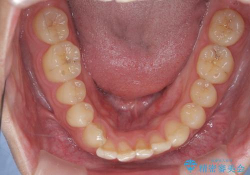 前歯のすれ違い マウスピース矯正の治療前