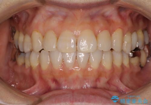 前歯の突出感と上下の隙間　インビザラインによる矯正治療