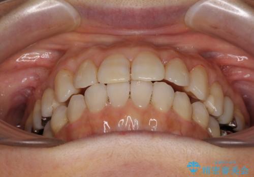 前歯の突出感と上下の隙間 インビザラインによる矯正治療の治療後