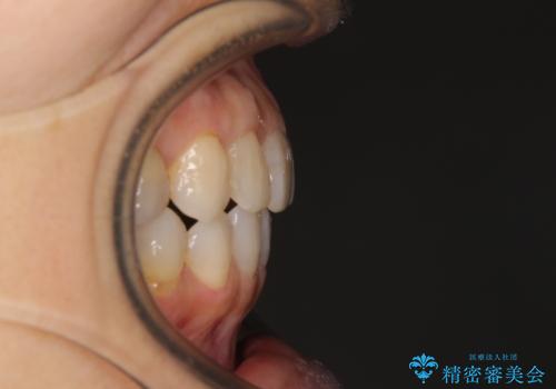 前歯の突出感と上下の隙間 インビザラインによる矯正治療の治療後