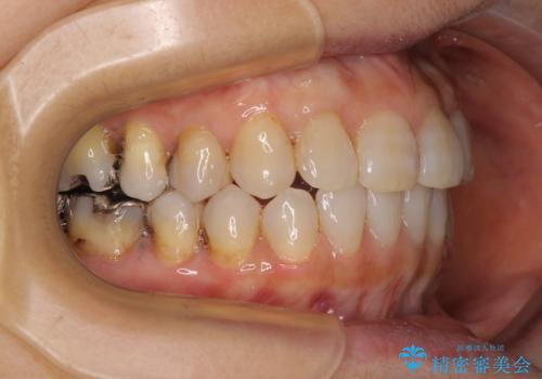 前歯の突出感と上下の隙間 インビザラインによる矯正治療の治療後