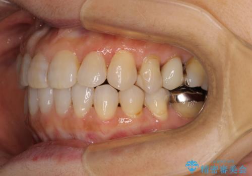 前歯の突出感と上下の隙間 インビザラインによる矯正治療の治療後