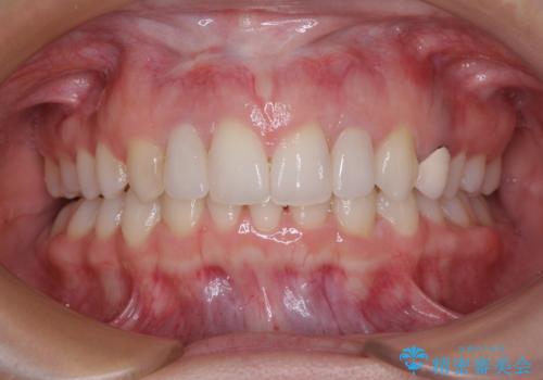 【モニター】前歯の変色とデコボコを改善　インビザラインとオールセラミック
