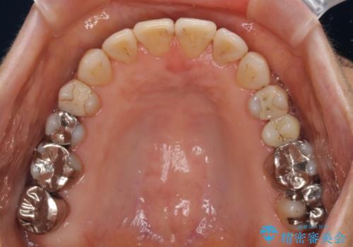 前歯の突出感と上下の隙間　インビザラインによる矯正治療の治療後