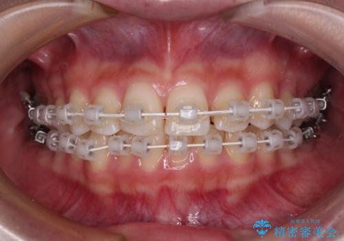 歯をきれいにしたい ワイヤー矯正治療と虫歯治療の治療中