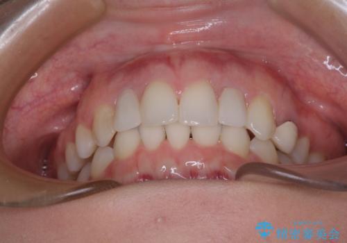 【モニター】前歯の変色とデコボコを改善　インビザラインとオールセラミックの治療後