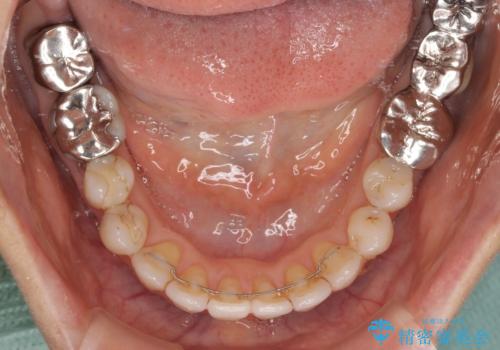 前歯の突出感と上下の隙間　インビザラインによる矯正治療の治療後